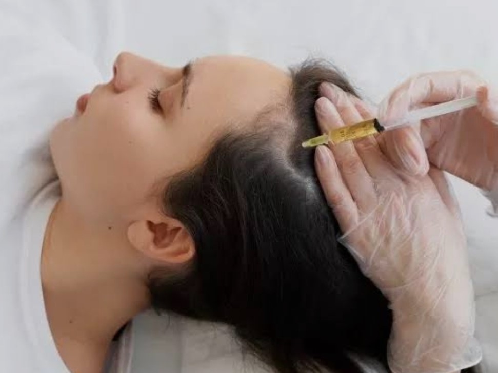 Tratamiento de bioestimulación capilar con PRP para frenar la caída del cabello